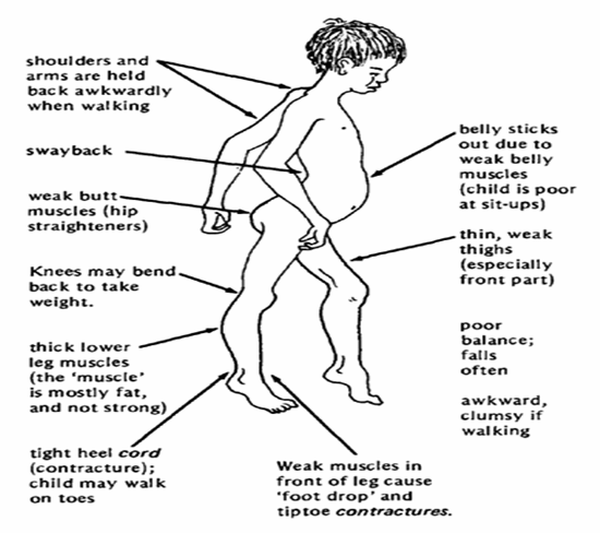 KENALI APA ITU MUSCULAR DYSTROPHY KENALI APA ITU MUSCULAR DYSTROPHY